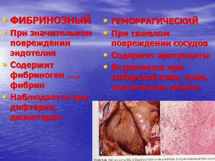  • ФИБРИНОЗНЫЙ • При значительном • ГЕМОРРАГИЧЕСКИЙ • При тяжелом • • повреждении