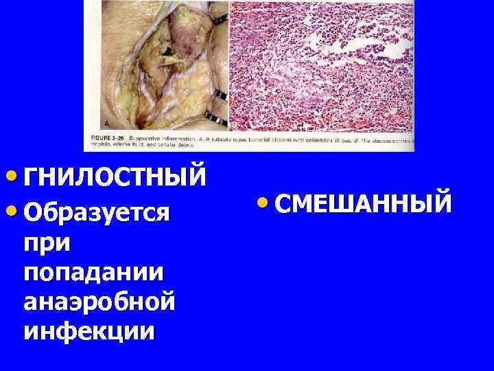  • ГНИЛОСТНЫЙ • Образуется при попадании анаэробной инфекции • СМЕШАННЫЙ 