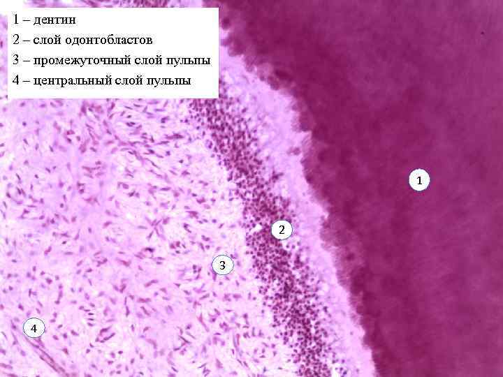 1 – дентин 2 – слой одонтобластов 3 – промежуточный слой пульпы 4 –