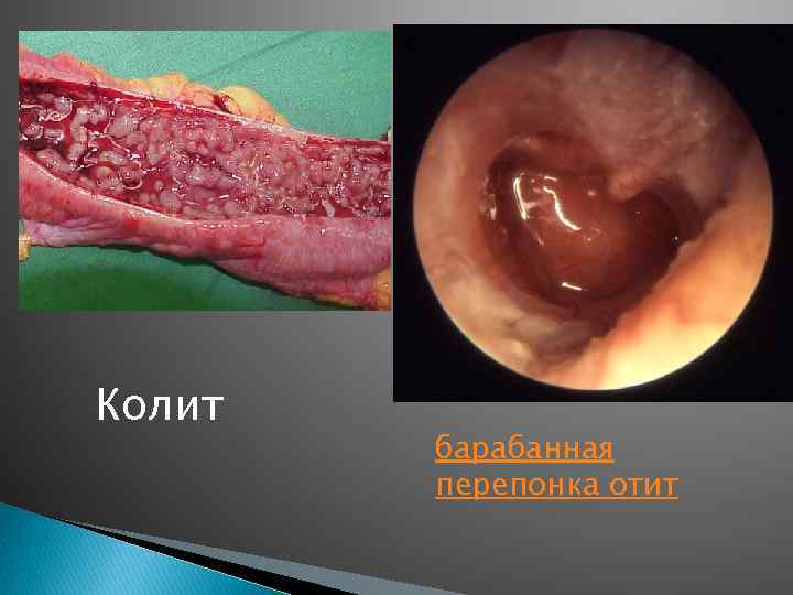 Колит барабанная перепонка отит 