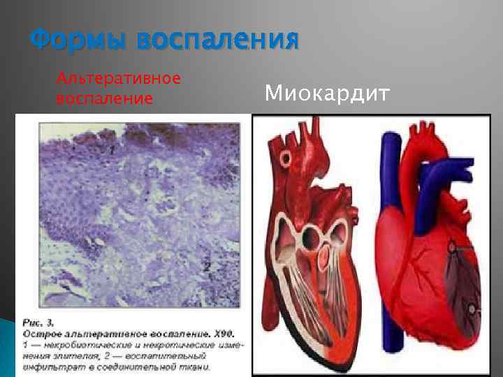 Острый миокардит презентация