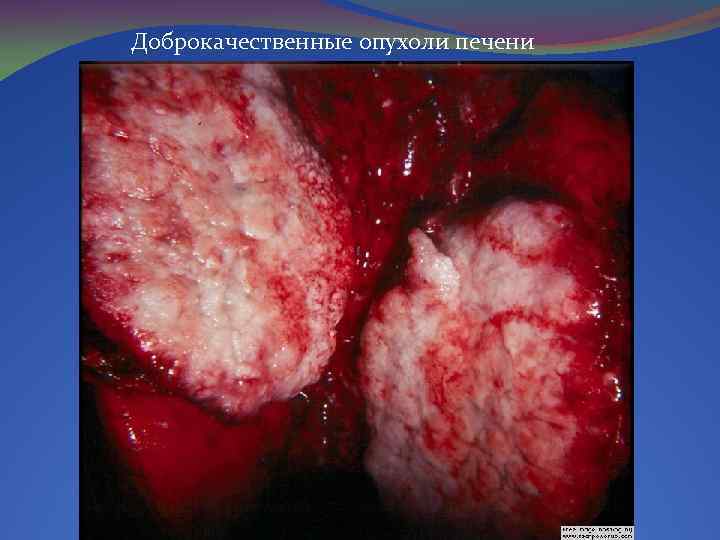 Доброкачественные опухоли печени 