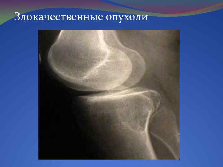 Злокачественные опухоли 