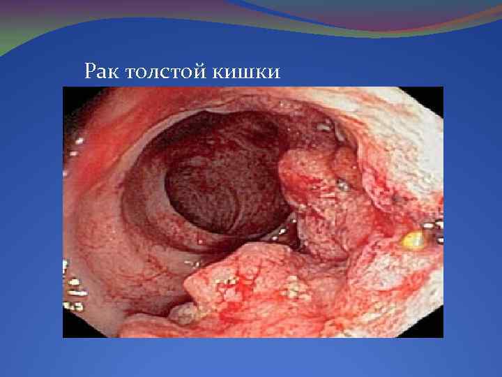 Рак толстой кишки 