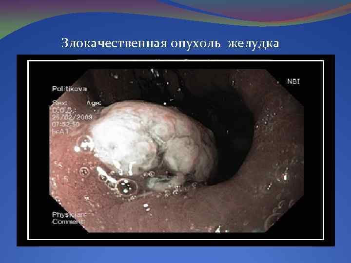 Злокачественная опухоль желудка 
