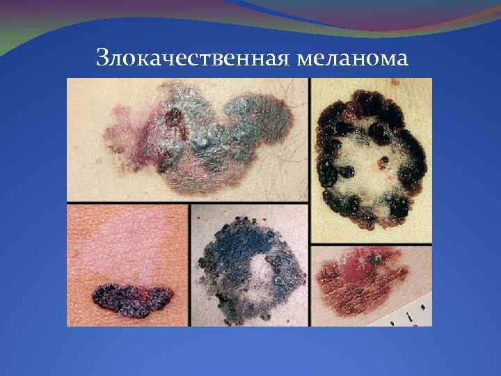 Злокачественная меланома 