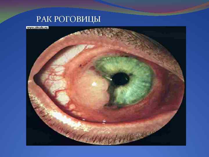 РАК РОГОВИЦЫ 