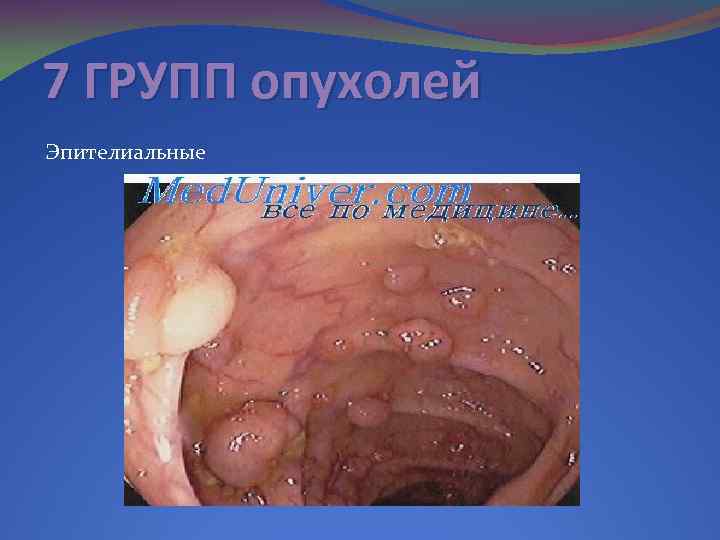 7 ГРУПП опухолей Эпителиальные 