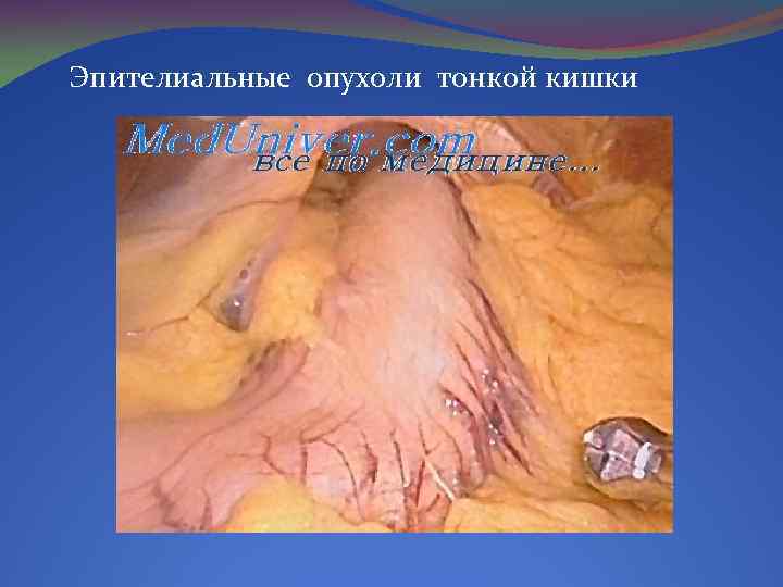 Эпителиальные опухоли тонкой кишки 