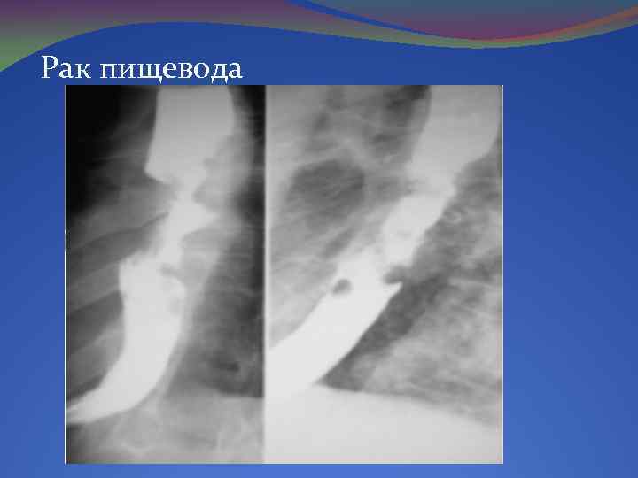 Рак пищевода 