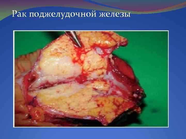 Рак поджелудочной железы 