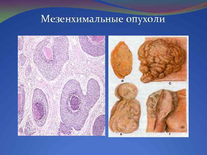 Мезенхимальные опухоли 