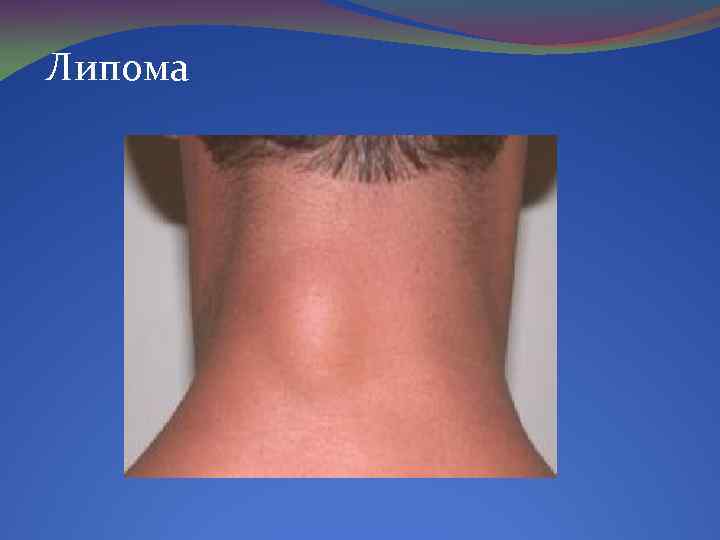 Липома 
