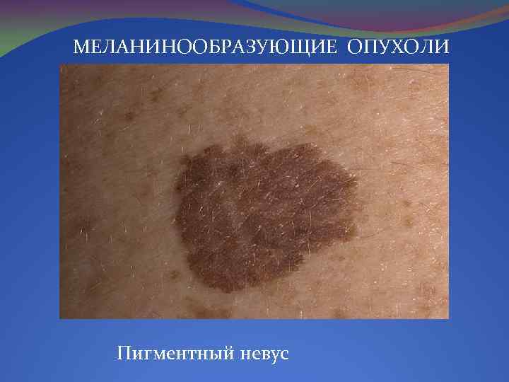 МЕЛАНИНООБРАЗУЮЩИЕ ОПУХОЛИ Пигментный невус 