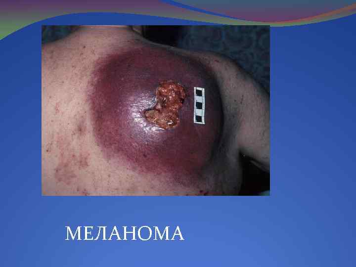 МЕЛАНОМА 