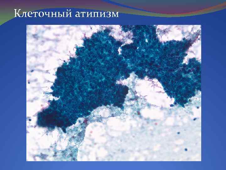 Клеточный атипизм 