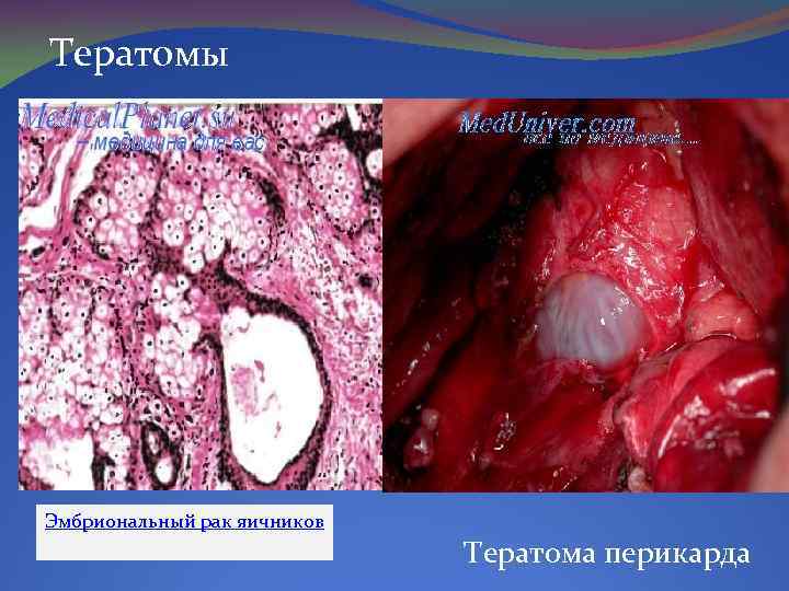 Тератомы Эмбриональный рак яичников Тератома перикарда 