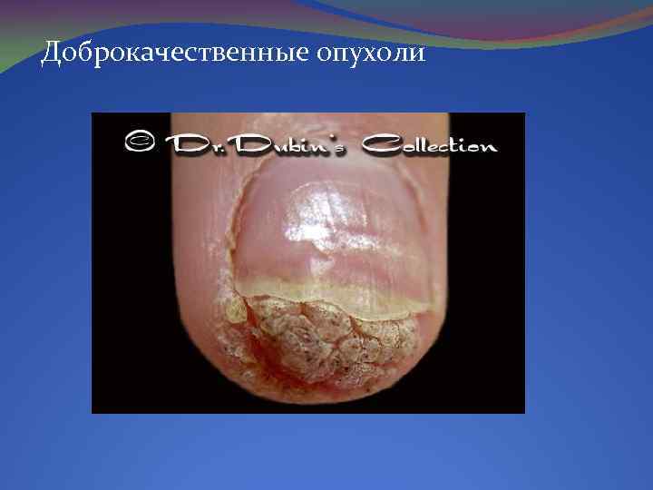 Доброкачественные опухоли 