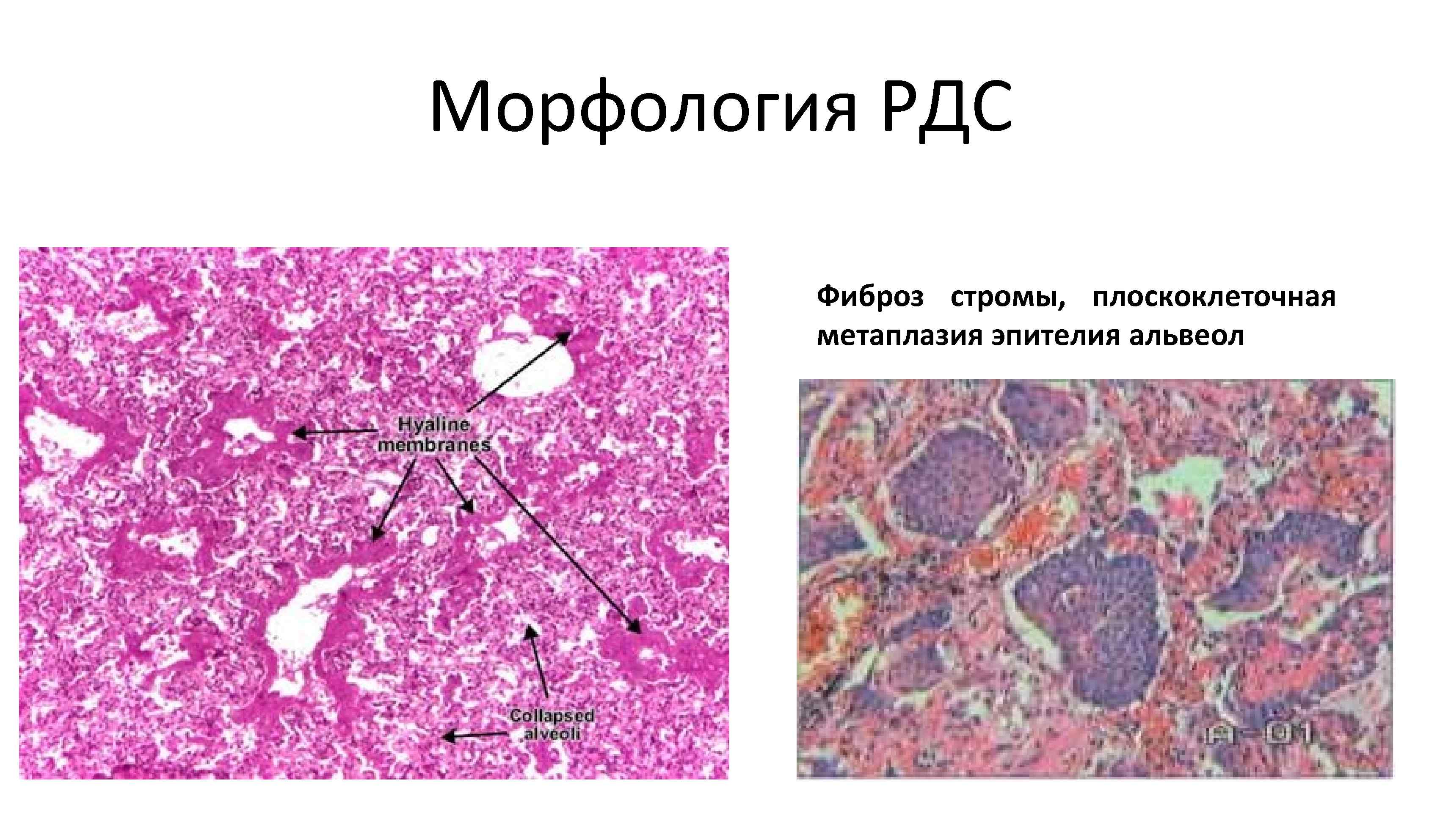 Морфология РДС Фиброз стромы, плоскоклеточная метаплазия эпителия альвеол 