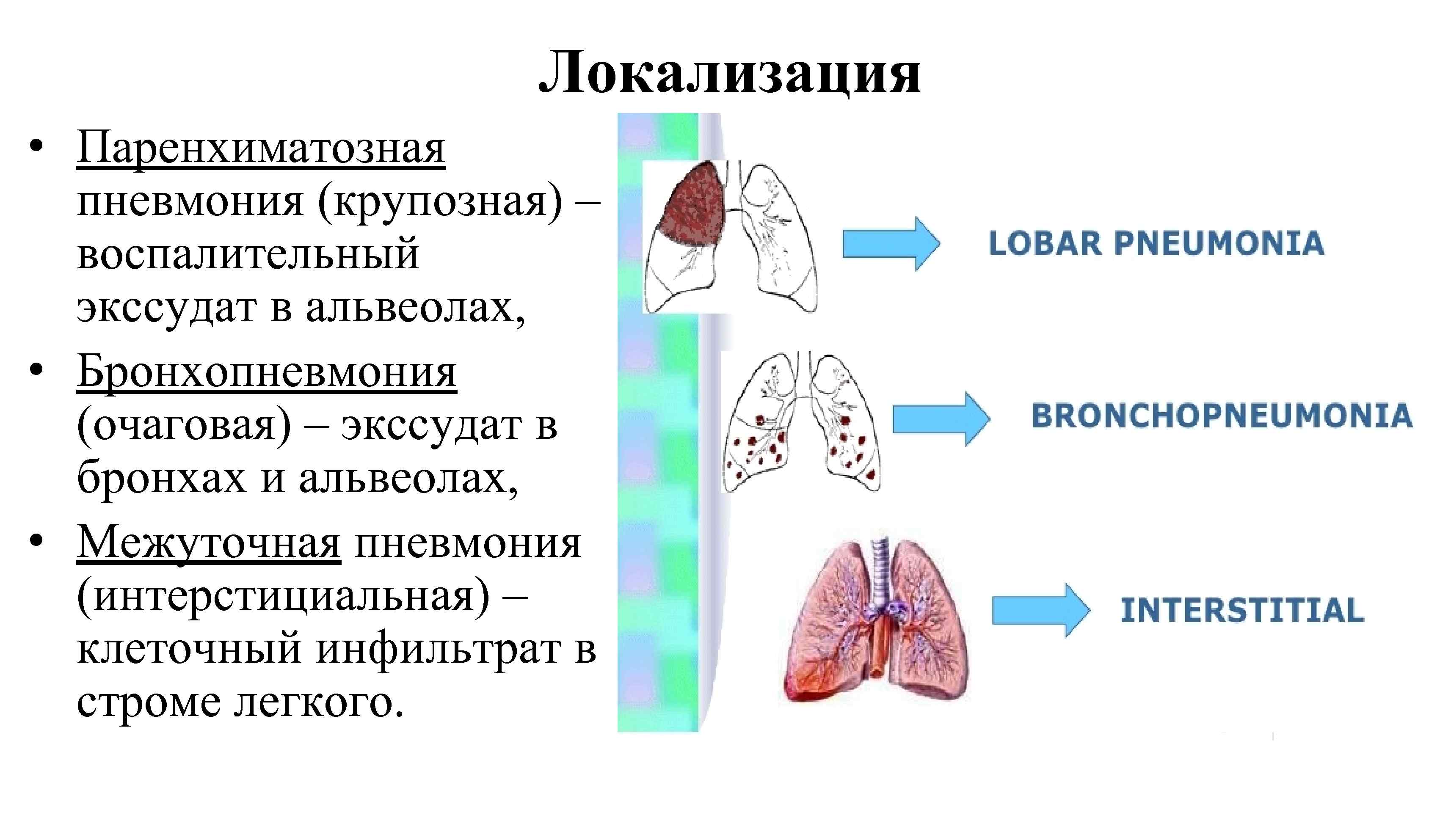 Локализация • Паренхиматозная пневмония (крупозная) – воспалительный экссудат в альвеолах, • Бронхопневмония (очаговая) –