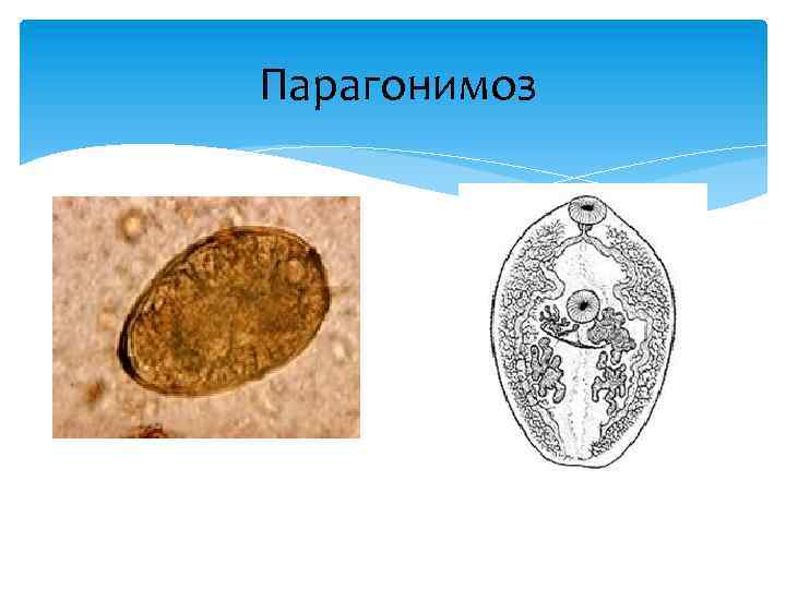 Парагонимоз 