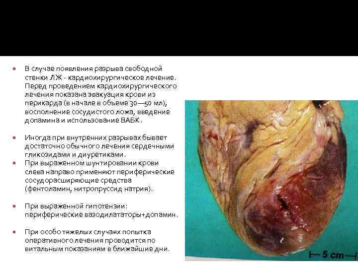  В случае появления разрыва свободной стенки ЛЖ - кардиохирургическое лечение. Перед проведением кардиохирургического