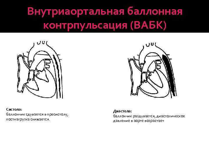 Внутриаортальная баллонная контрпульсация (ВАБК) Систола: баллончик сдувается в пресистолу, постнагрузка снижается. Диастола: баллончик раздувается,