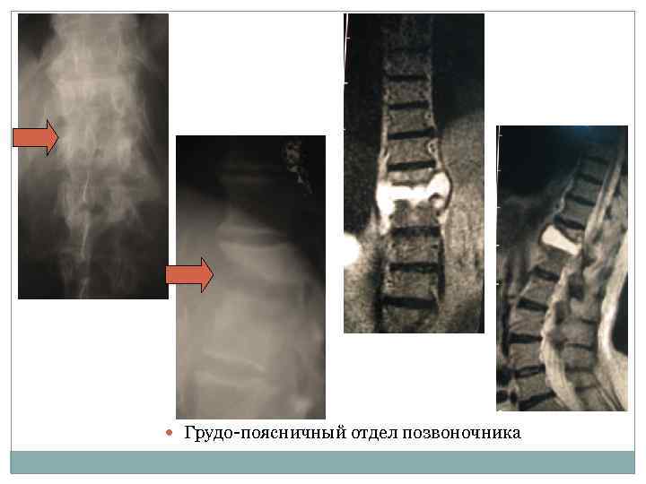  Грудо-поясничный отдел позвоночника 
