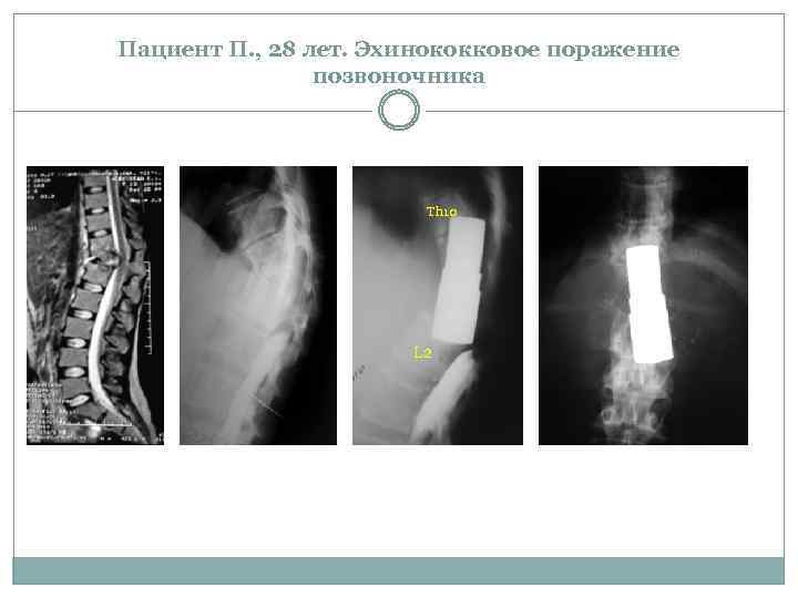 Пациент П. , 28 лет. Эхинококковое поражение позвоночника Th 10 L 2 