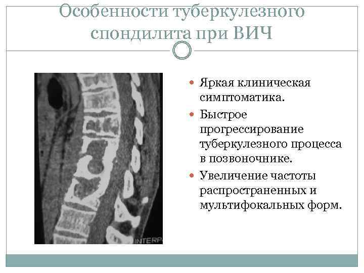 Особенности туберкулезного спондилита при ВИЧ Яркая клиническая симптоматика. Быстрое прогрессирование туберкулезного процесса в позвоночнике.