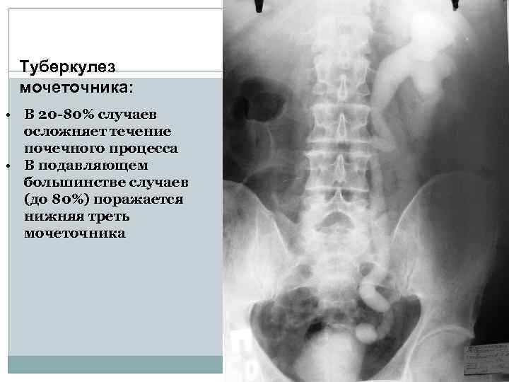 Для рентгенологической картины туберкулеза почки характерна