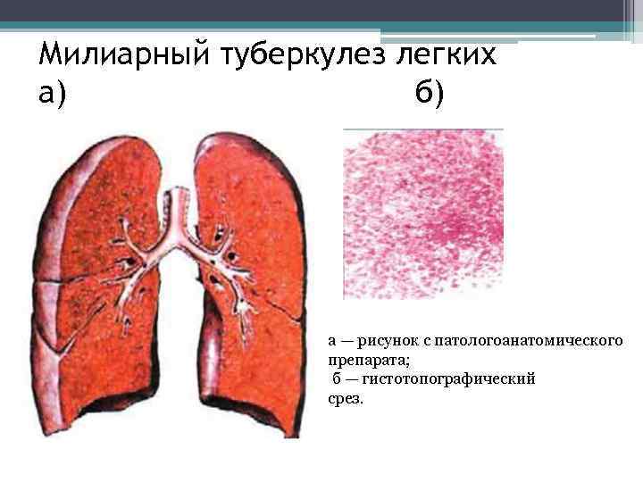 Милиарный туберкулез легких а) б) а — рисунок с патологоанатомического препарата; б — гистотопографический