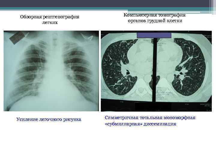 Обзорная рентгенография легких Усиление легочного рисунка Компьютерная томография органов грудной клетки Симметричная тотальная мономорфная