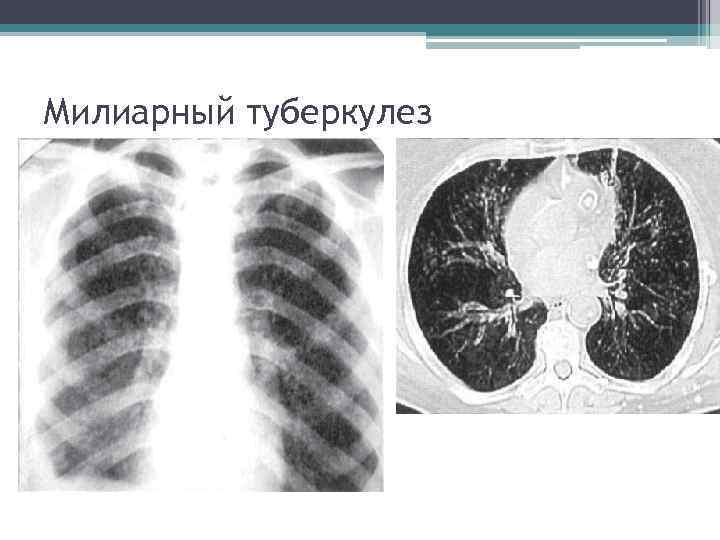 Милиарный туберкулез 14 -й день болезни 