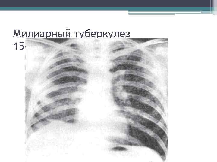 Милиарный туберкулез 15 -й день болезни 