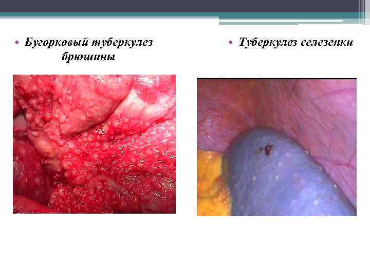  • Бугорковый туберкулез брюшины • Туберкулез селезенки 