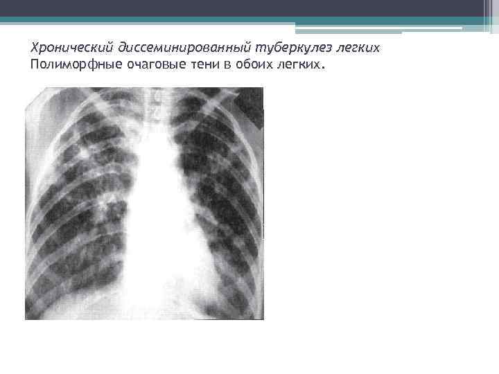 Хронический диссеминированный туберкулез легких Полиморфные очаговые тени в обоих легких. 