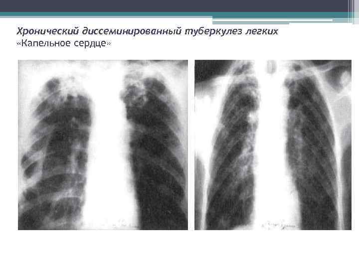 Хронический диссеминированный туберкулез легких «Капельное сердце» 