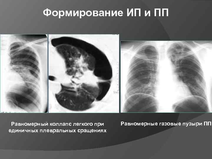 Формирование ИП и ПП Равномерный коллапс легкого при единичных плевральных сращениях Равномерные газовые пузыри