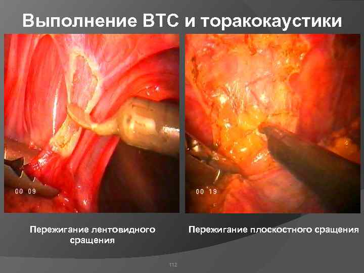 Выполнение ВТС и торакокаустики Пережигание лентовидного сращения Пережигание плоскостного сращения 112 