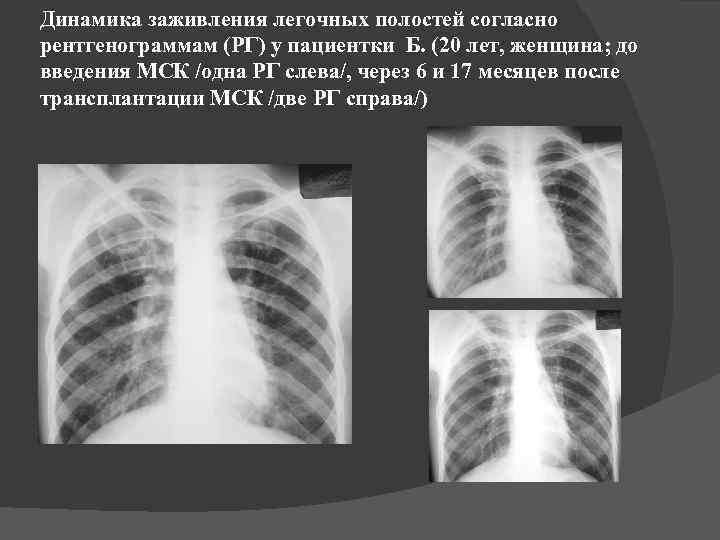 Динамика заживления легочных полостей согласно рентгенограммам (РГ) у пациентки Б. (20 лет, женщина; до