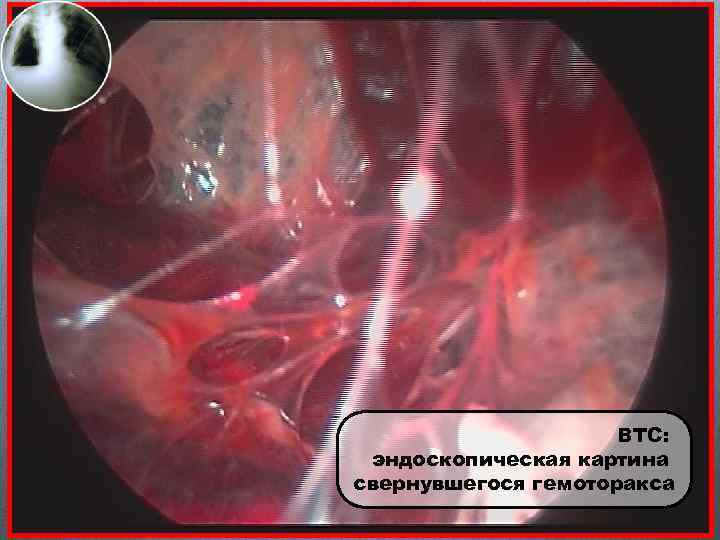 ВТС: эндоскопическая картина свернувшегося гемоторакса 