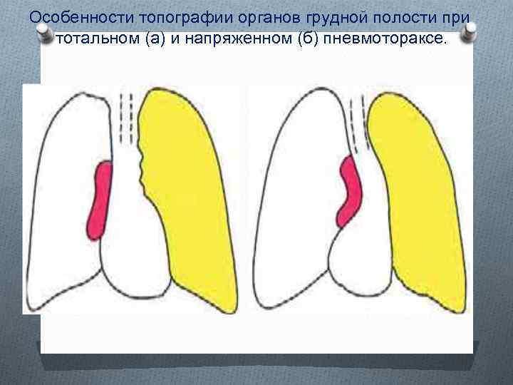 Особенности топографии органов грудной полости при тотальном (а) и напряженном (б) пневмотораксе. 