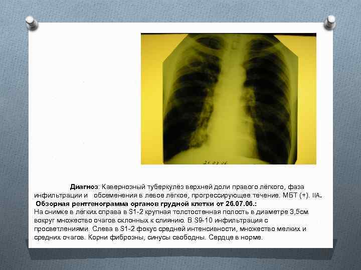 Диагноз: Кавернозный туберкулёз верхней доли правого лёгкого, фаза инфильтрации и обсеменения в левое лёгкое,