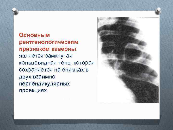 Основным рентгенологическим признаком каверны является замкнутая кольцевидная тень, которая сохраняется на снимках в двух