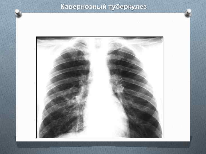 Рентгенологическая картина более характерная для кавернозного туберкулеза