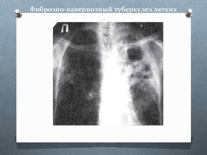 Фиброзно-кавернозный туберкулез легких 