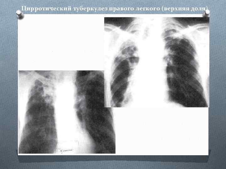 Цирротический туберкулез правого легкого (верхняя доля) 
