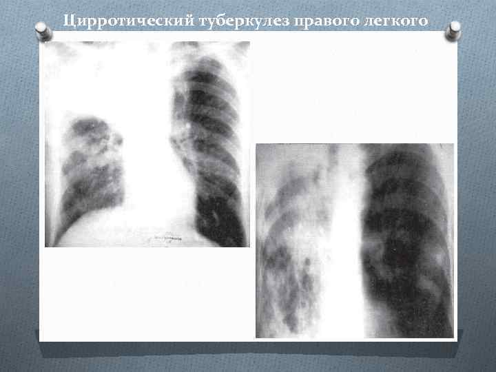 Цирротический туберкулез правого легкого 