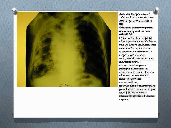 Диагноз: Цирротический туберкулёз правого лёгкого , фаза инфильтрации, ВК(+). IIБ. Обзорная рентгенограмма органов грудной